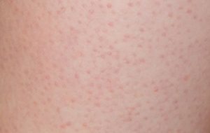 chronic prostatitis chronic prostatitis